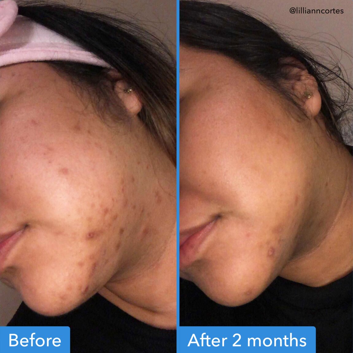 discoloration-correcting-serum-b4 zb_p.jpg