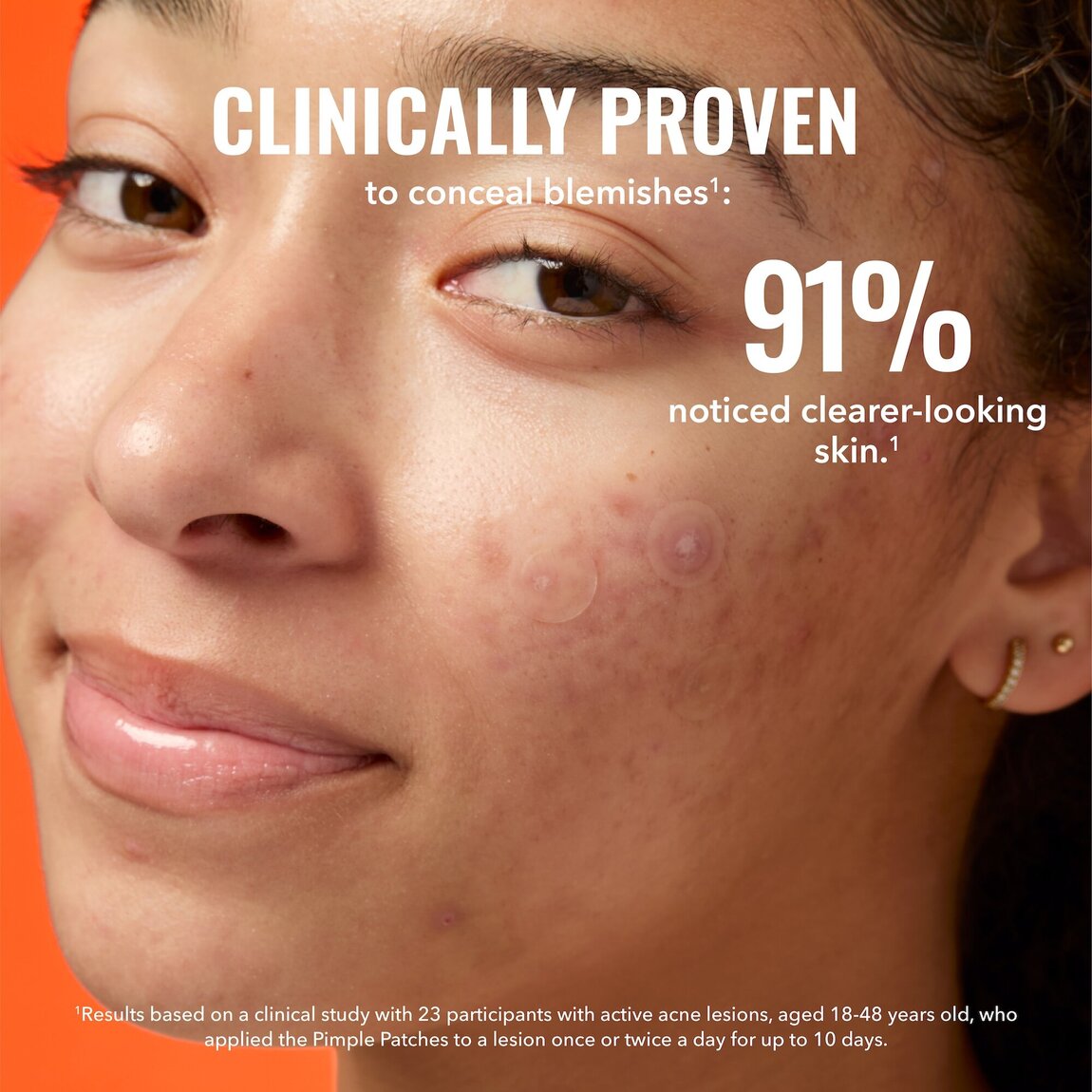 pimple-patches-a2 zb_p.jpg